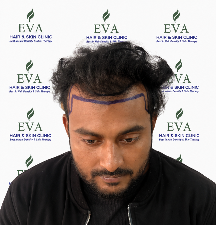 Before hair transplant result 6
